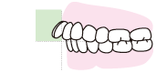出っ歯の図